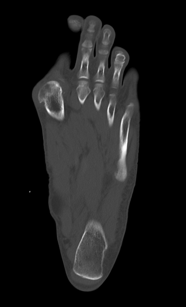 File:Anterior calcaneal process fracture (Radiopaedia 47384-51989 Axial bone window 25).png
