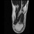 Anterior calcaneal process fracture (Radiopaedia 74654-85611 Axial T2 27).jpg