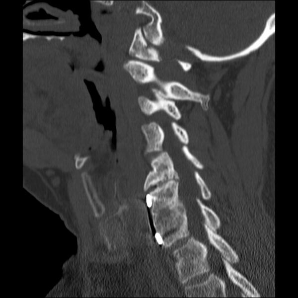 File:Anterior cervical postdiscectomy arthrodesis (Radiopaedia 32678-33646 Sagittal bone window 48).jpg