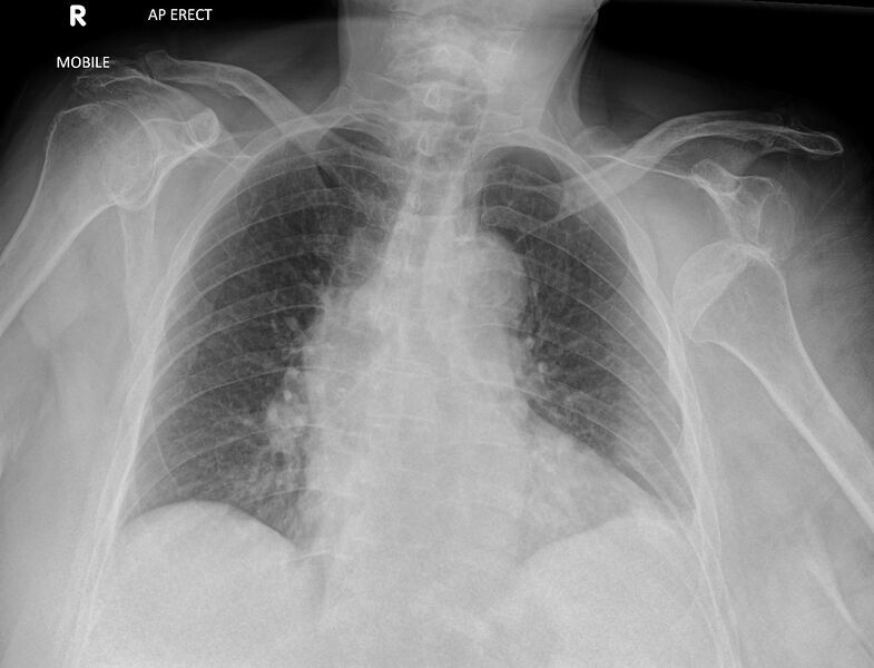 File:Anterior shoulder dislocation (Radiopaedia 86818).jpg