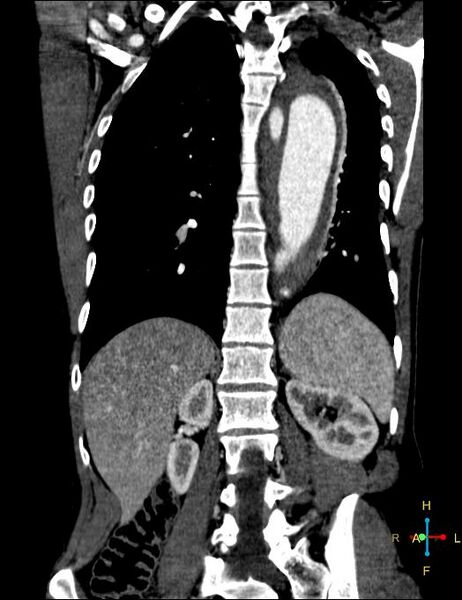 File:Aortic aneurysm and penetrating ulcer (Radiopaedia 23590-23704 B 19).jpg