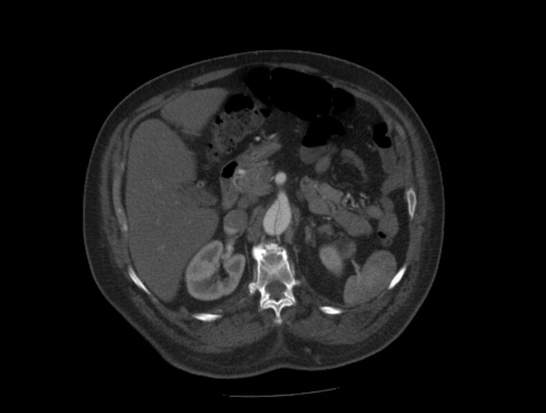 File:Aortic dissection (Radiopaedia 28802-29105 A 50).jpg