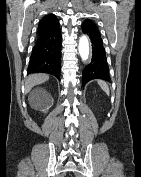 File:Aortic dissection (Radiopaedia 44411-48061 A 56).jpg