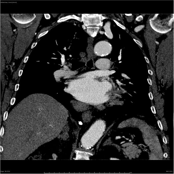 File:Aortic dissection - Stanford type A (Radiopaedia 26183-26315 A 38).jpg