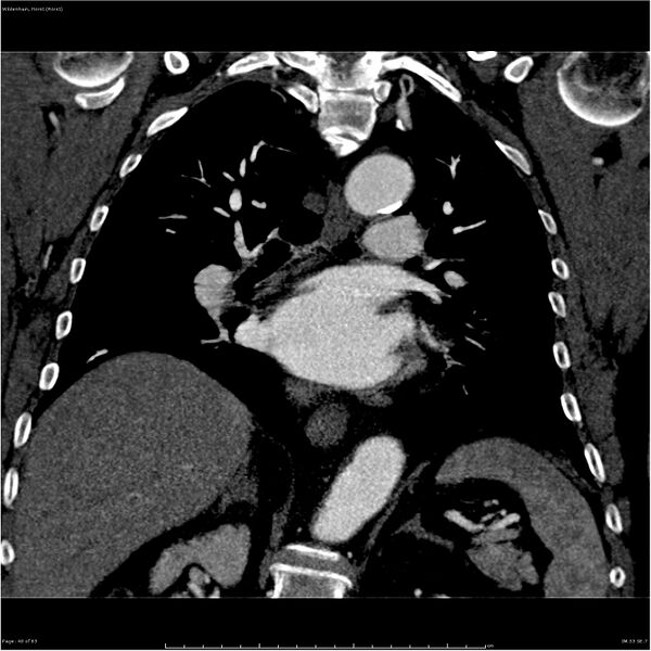 File:Aortic dissection - Stanford type A (Radiopaedia 26183-26315 A 40).jpg
