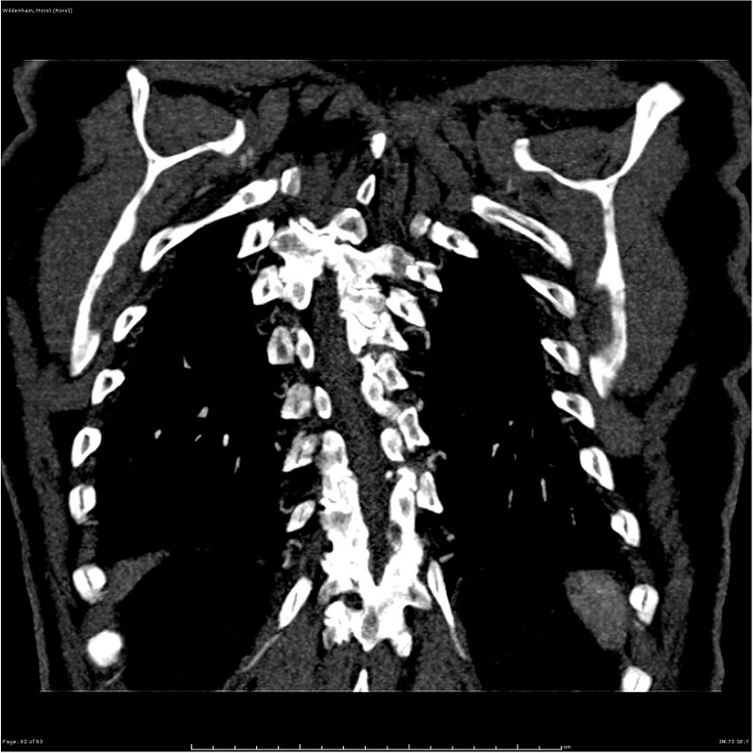Aortic dissection - Stanford type A (Radiopaedia 26183-26315 A 62).jpg