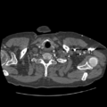 Aorto-coronary bypass graft aneurysms (Radiopaedia 40562-43157 A 11).png