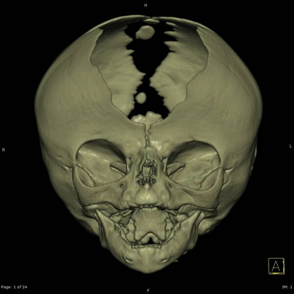 File:Apert syndrome with syndactyly (Radiopaedia 10315-10834 3D MPR bone window 1).jpg