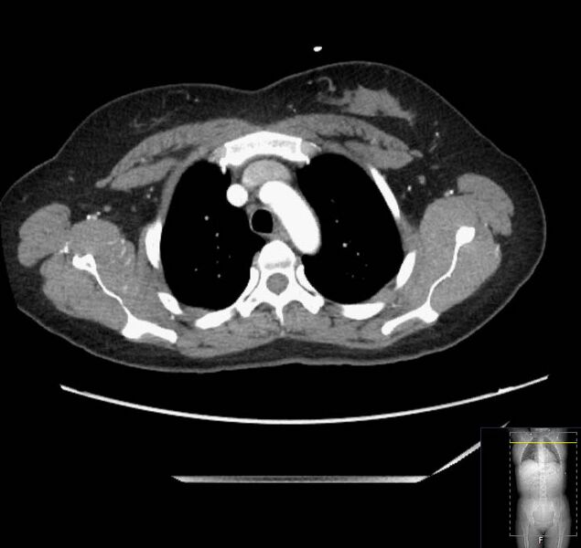 File:Appendicitis (CT angiogram) (Radiopaedia 154713-127660 Axial 223).jpg