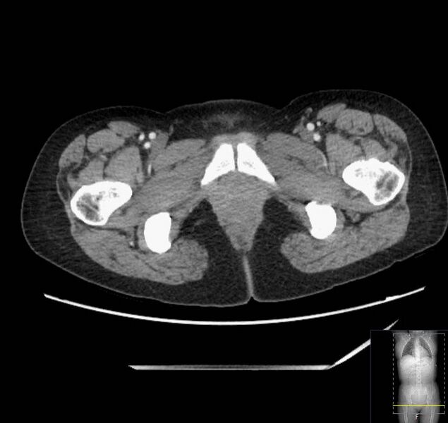 File:Appendicitis (CT angiogram) (Radiopaedia 154713-127660 Axial 96).jpg