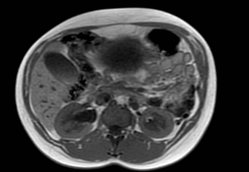 File:Appendicitis in gravida (MRI) (Radiopaedia 89433-106395 Axial T1 in-phase 24).jpg