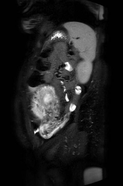 File:Appendicitis in gravida (MRI) (Radiopaedia 89433-106395 Sagittal T2 SPAIR 14).jpg