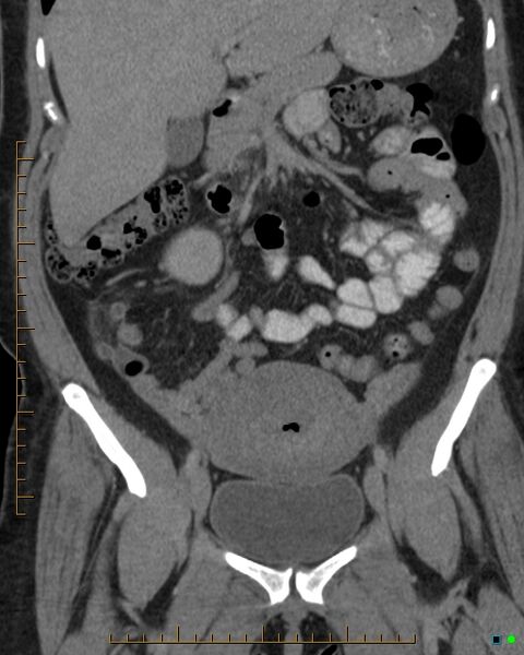 File:Appendicitis post recent cesarian section (Radiopaedia 29594-30102 D 10).jpg