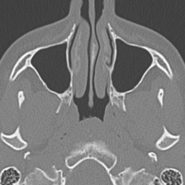 File:Arrested pneumatization of the sphenoid (Radiopaedia 10700-11172 Axial non-contrast 14).jpg