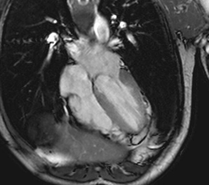 File:Arrhythmogenic right ventricular cardiomyopathy (Radiopaedia 39806-42237 D 79).jpg