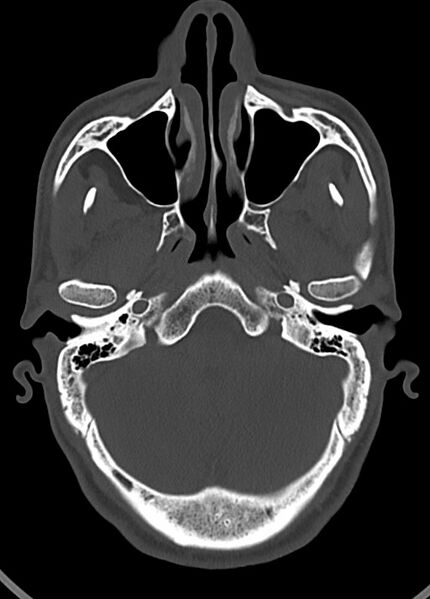 File:Arrow injury to the head (Radiopaedia 75266-86388 Axial bone window 49).jpg