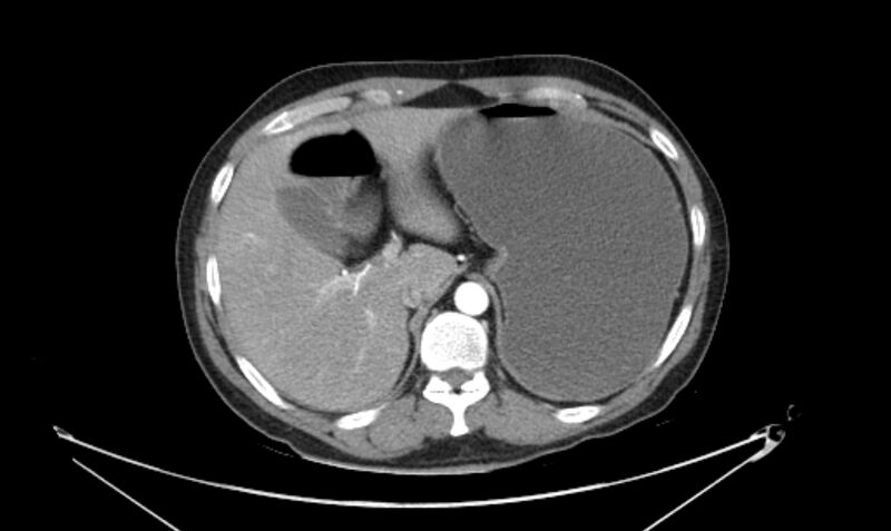 File:Arterial occlusive mesenteric ischemia (Radiopaedia 84641-100060 A 32).jpg
