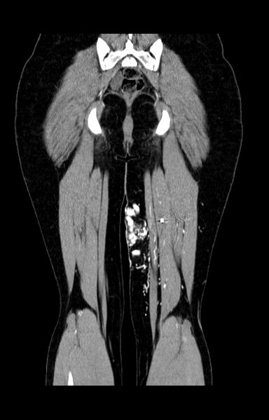 File:Arteriovenous malformation of the thigh (Radiopaedia 14948-14883 C+ arterial phase 21).jpg