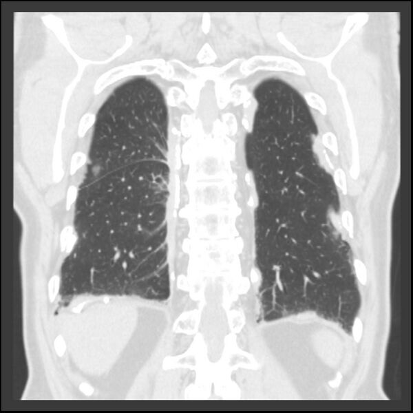 File:Asbestos-related pleural plaques (Radiopaedia 39069-41255 Coronal lung window 17).jpg