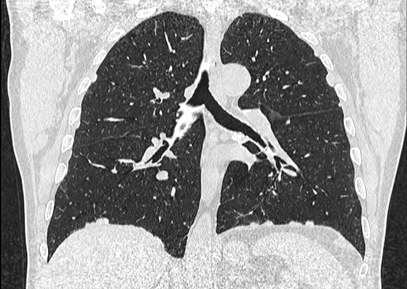 File:Asbestos pleural placques (Radiopaedia 57905-64872 Coronal lung window 169).jpg