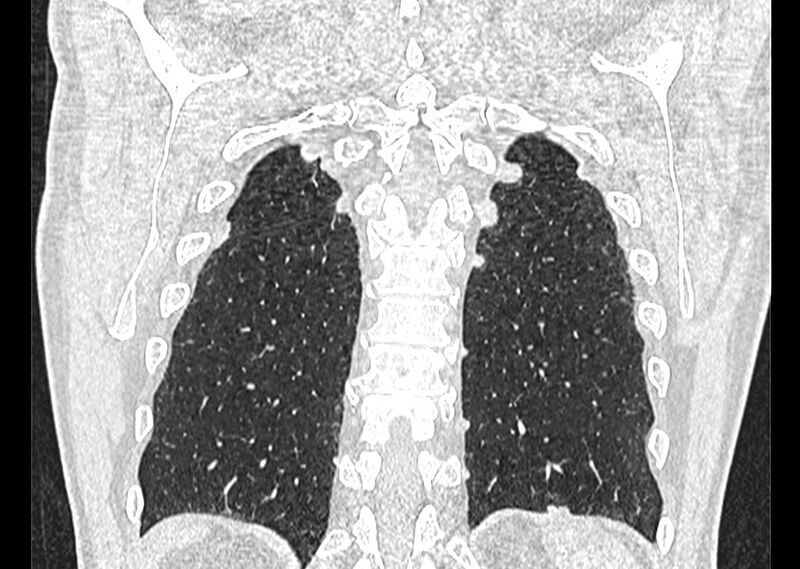 File:Asbestos pleural placques (Radiopaedia 57905-64872 Coronal lung window 244).jpg