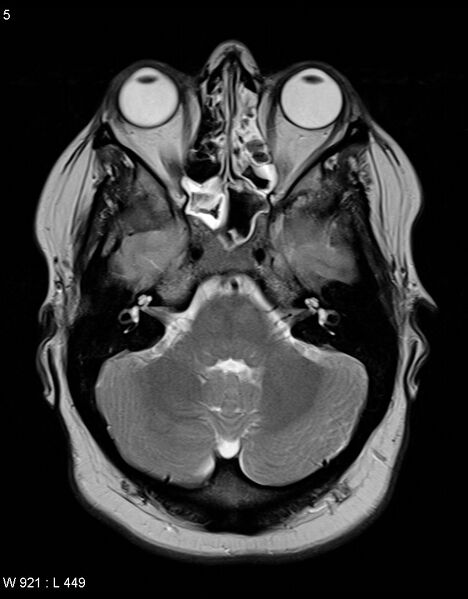 File:Astroblastoma (Radiopaedia 39792-42217 Axial T2 4).jpg