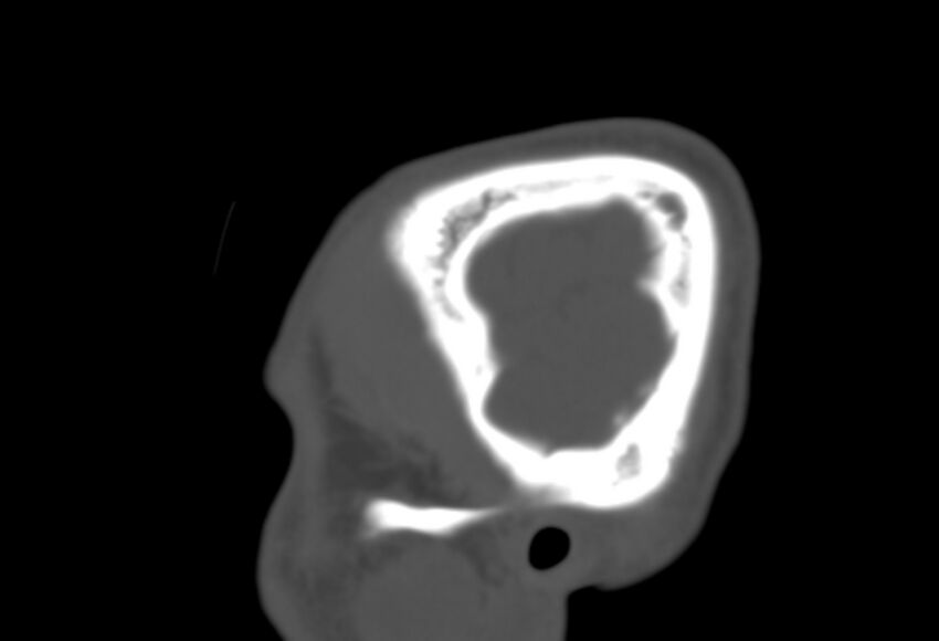 Asymptomatic occipital spur (Radiopaedia 87753-104201 Sagittal bone window 12).jpg