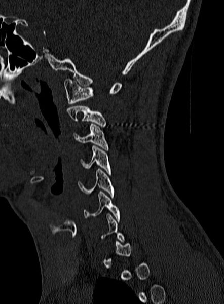 File:Atlantoaxial subluxation (Radiopaedia 44681-48450 Sagittal bone window 10).jpg