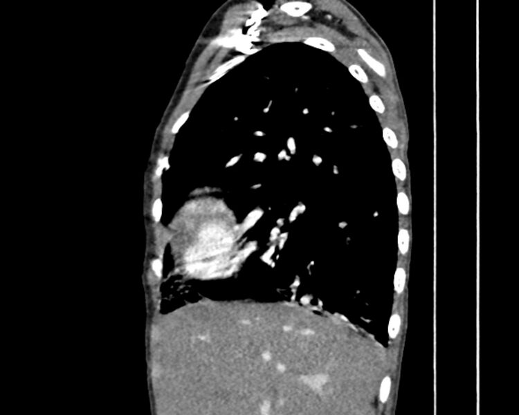 File:Atrial septal defect complicated by Eisenmenger syndrome (Radiopaedia 53707-59768 Sagittal C+ CTPA 6).jpg