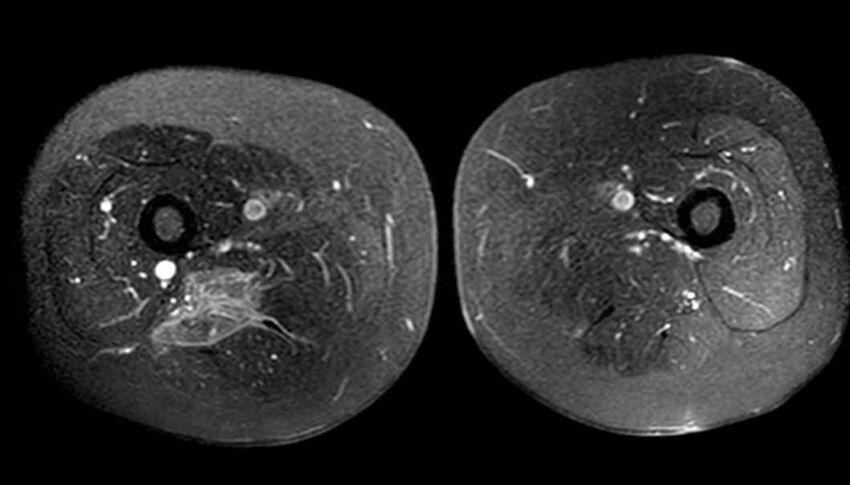 Atypical lipomatous tumor - thigh (Radiopaedia 68975-78734 Axial T1 C+ fat sat 58).jpg