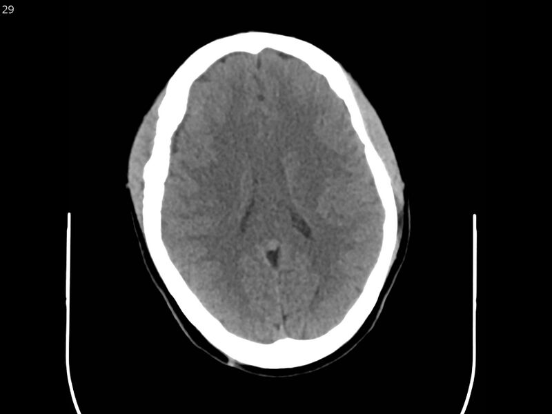 File:Atypical meningioma - intraosseous (Radiopaedia 64915-73867 A 29).jpg