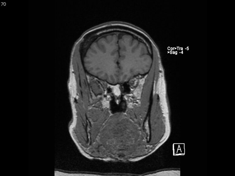 File:Atypical meningioma - intraosseous (Radiopaedia 64915-74572 Coronal T1 70).jpg