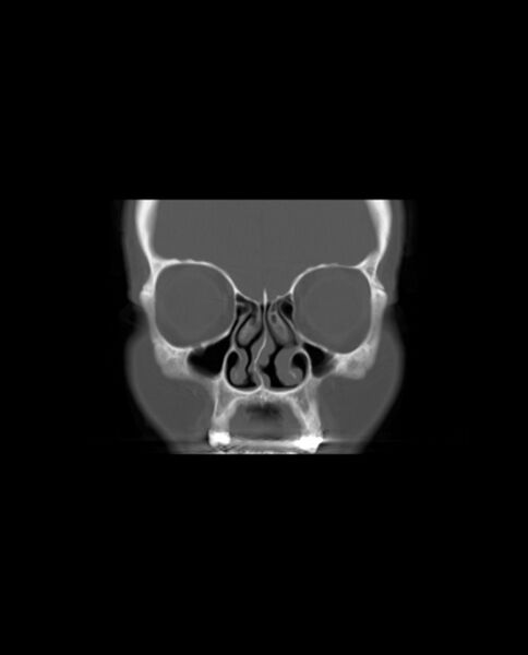 File:Automastoidectomy with labyrinthine fistula (Radiopaedia 84143-99411 Coronal non-contrast 20).jpg