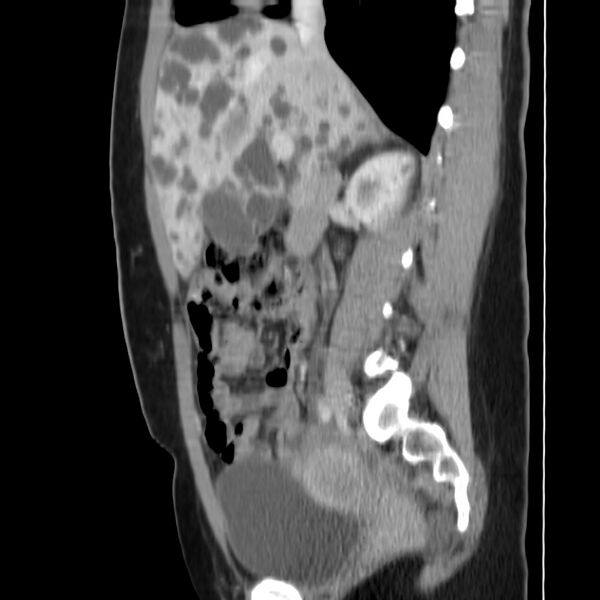 File:Autosomal dominant polycystic kidney disease (Radiopaedia 23061-23093 F 22).jpg