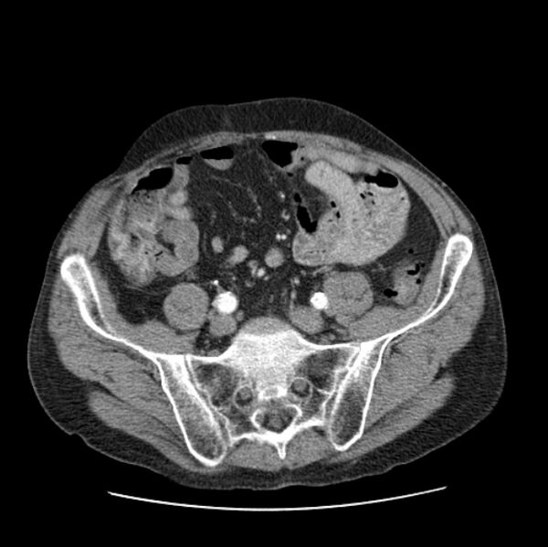 File:Autosomal dominant polycystic kidney disease (Radiopaedia 27851-28094 B 96).jpg