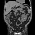 Autosomal dominant polycystic kidney disease (Radiopaedia 36539-38101 C 27).jpg