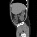 Autosomal dominant polycystic kidney disease (Radiopaedia 36539-38101 D 14).jpg