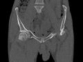 Avascular necrosis of the left hip (Radiopaedia 75068-86125 Coronal bone window 2).jpg