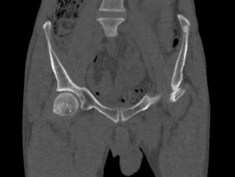 File:Avascular necrosis of the left hip (Radiopaedia 75068-86125 Coronal bone window 2).jpg