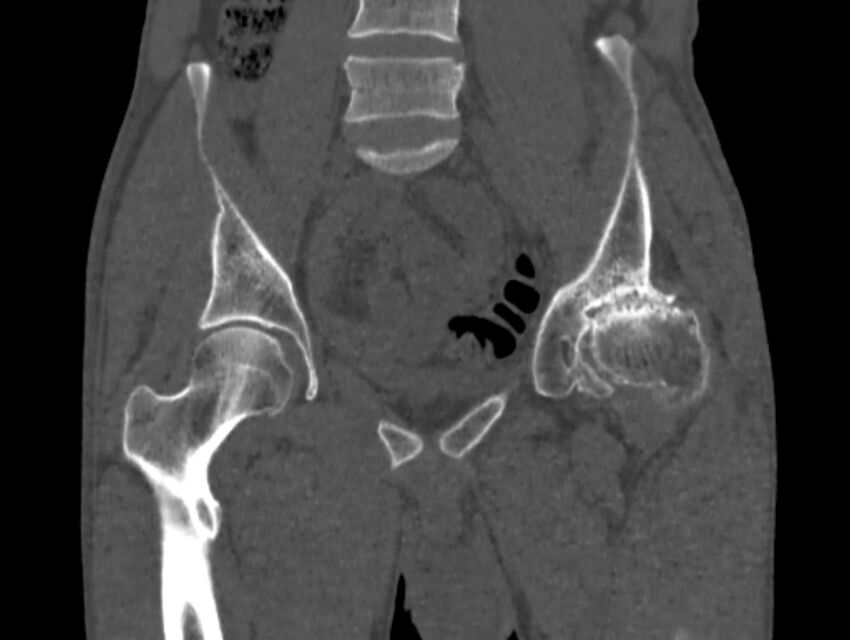 Avascular necrosis of the left hip (Radiopaedia 75068-86125 Coronal bone window 22).jpg