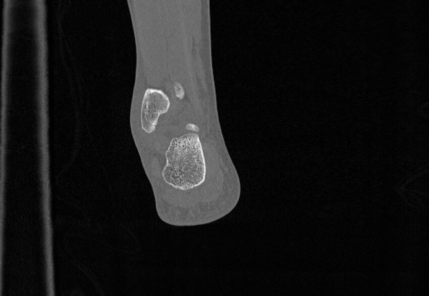 Avulsion fractures of talus and calcaneus (Radiopaedia 48277-53155 Coronal bone window 86).jpg