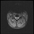 Axis fracture - MRI (Radiopaedia 71925-82375 Axial T2 fat sat 11).jpg