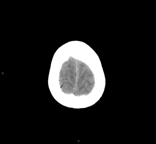 File:Basal ganglia hemorrhage (Radiopaedia 58775-66008 Axial non-contrast 11).jpg
