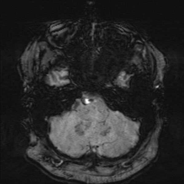 File:Basilar artery dissection (Radiopaedia 77032-88976 Axial SWI 11).jpg