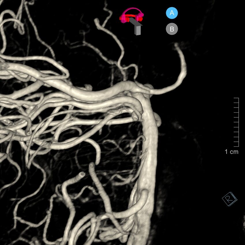 Basilar artery perforator aneurysm (Radiopaedia 82455-97734 3D view left VA 134).jpg