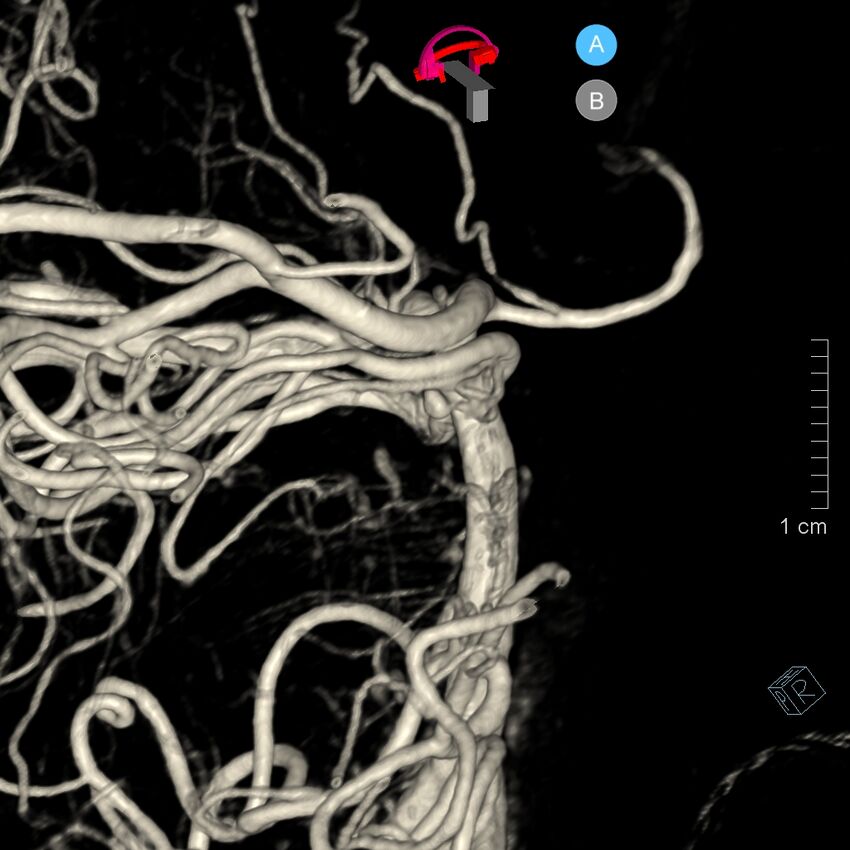 Basilar artery perforator aneurysm (Radiopaedia 82455-97734 3D view left VA 142).jpg