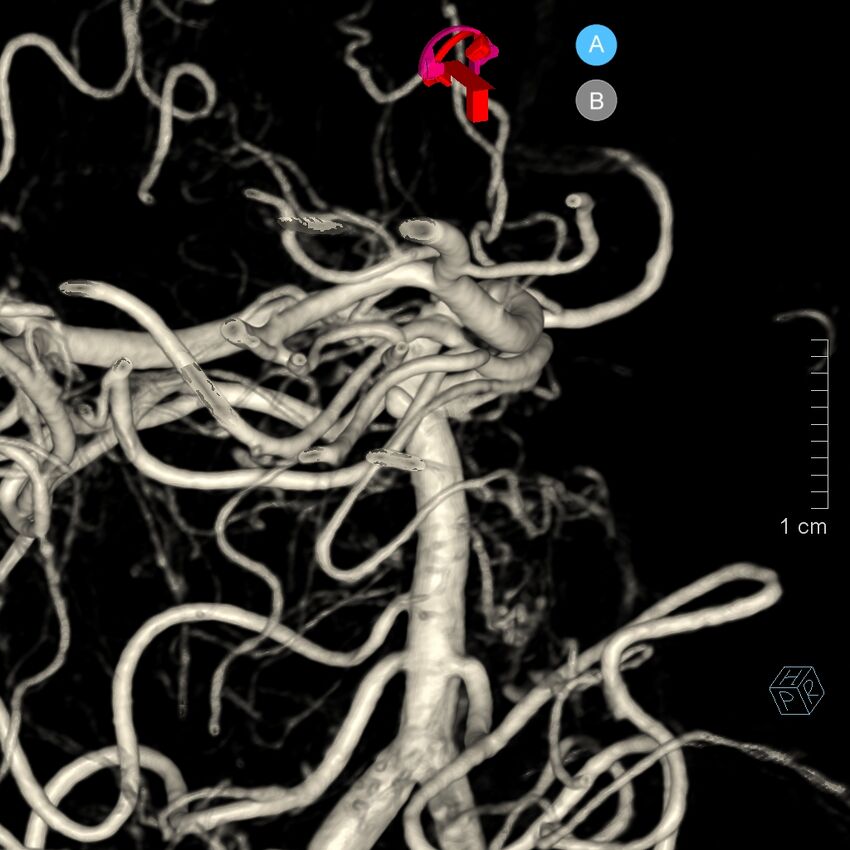 Basilar artery perforator aneurysm (Radiopaedia 82455-97734 3D view left VA 150).jpg