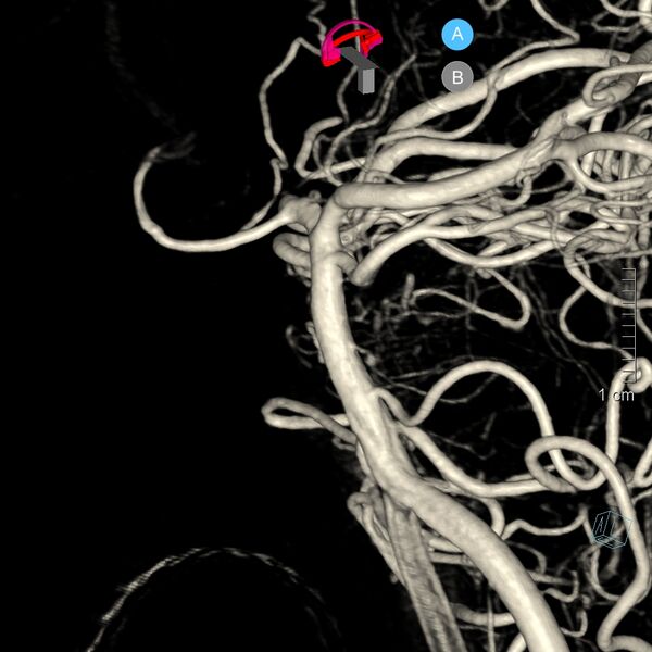 File:Basilar artery perforator aneurysm (Radiopaedia 82455-97734 3D view left VA 27).jpg