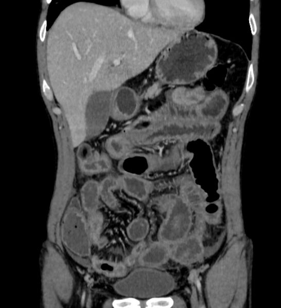 File:Behçet's disease- abdominal vasculitis (Radiopaedia 55955-62570 B 14).jpg