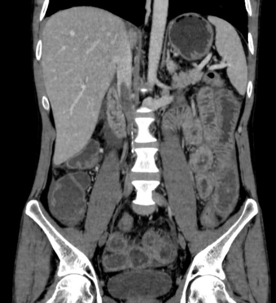 File:Behçet's disease- abdominal vasculitis (Radiopaedia 55955-62570 B 32).jpg